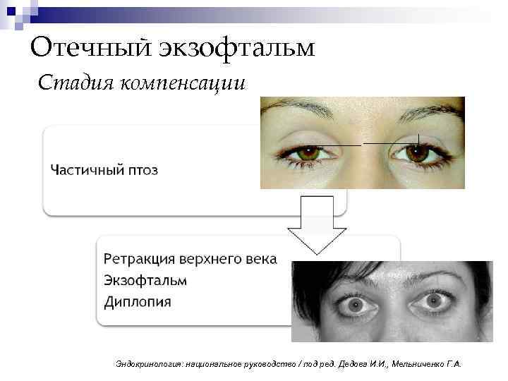 Отечный экзофтальм Стадия компенсации Эндокринология: национальное руководство / под ред. Дедова И. И. ,
