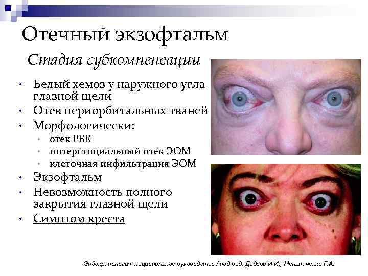 Отечный экзофтальм Стадия субкомпенсации • • • Белый хемоз у наружного угла глазной щели