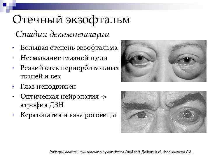 Отечный экзофтальм Стадия декомпенсации • • • Большая степень экзофтальма Несмыкание глазной щели Резкий