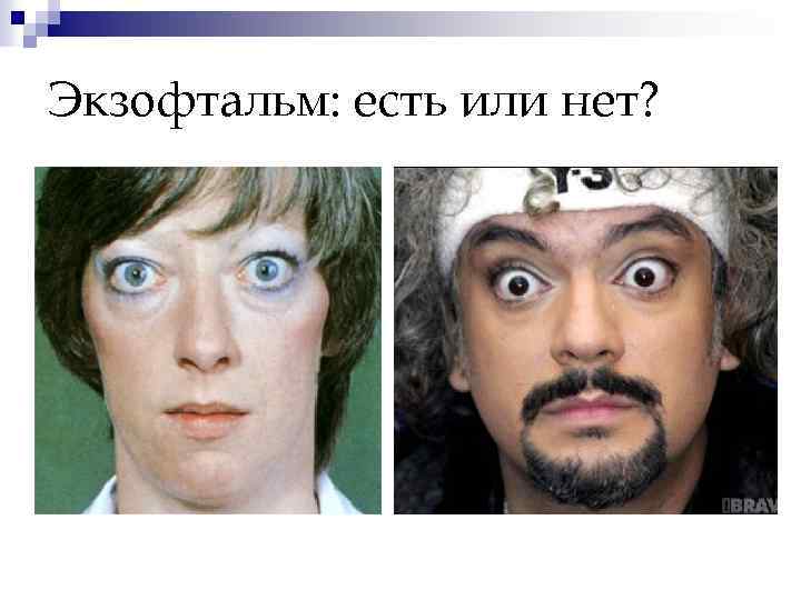 Экзофтальм: есть или нет? 