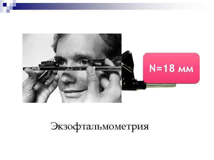 N=18 мм Экзофтальмометрия 