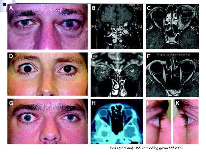Br J Ophtalmol, BMJ Publishing group Ltd 2009 