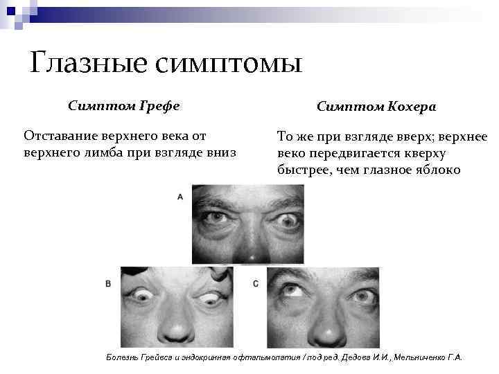 Глазные симптомы Симптом Грефе Отставание верхнего века от верхнего лимба при взгляде вниз Симптом