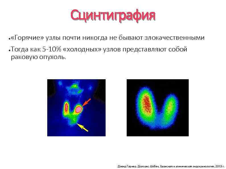 Сцинтиграмма является изображением