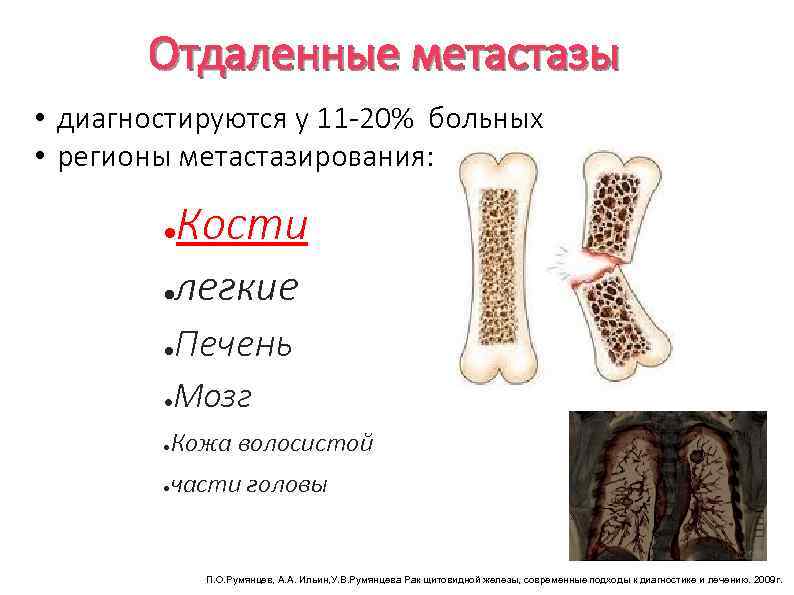 Отдаленные метастазы • диагностируются у 11 -20% больных • регионы метастазирования: ● ● Кости