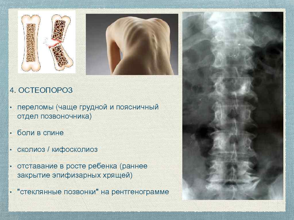 4. ОСТЕОПОРОЗ • переломы (чаще грудной и поясничный отдел позвоночника) • боли в спине