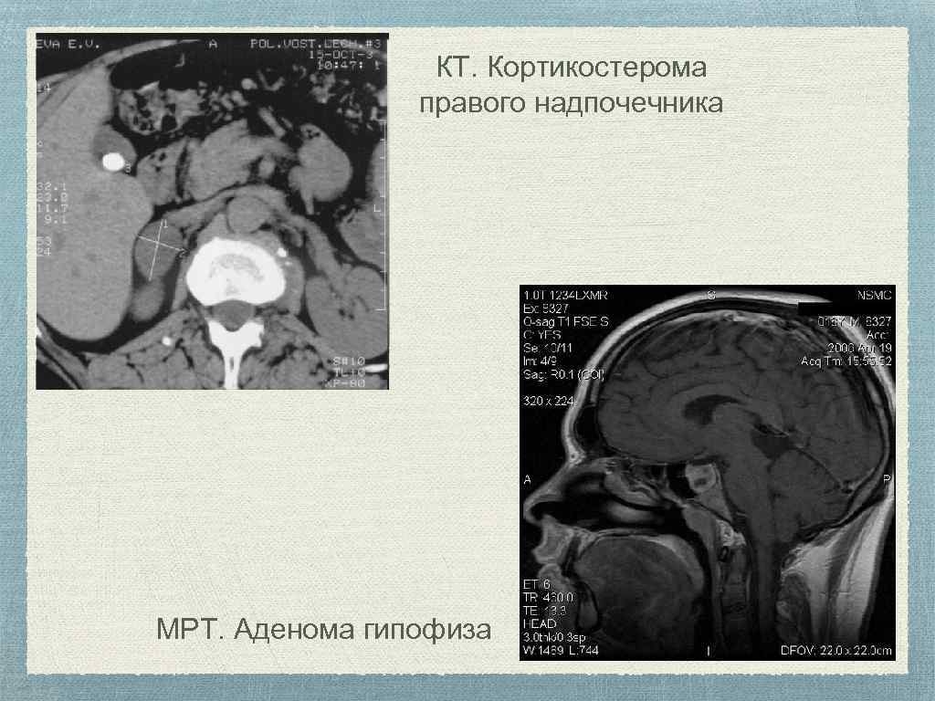 Синдром гипофиза