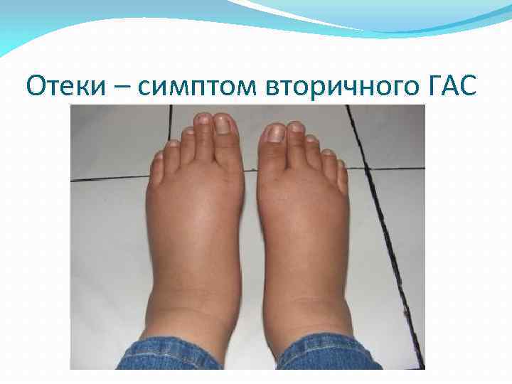 Отеки – симптом вторичного ГАС 