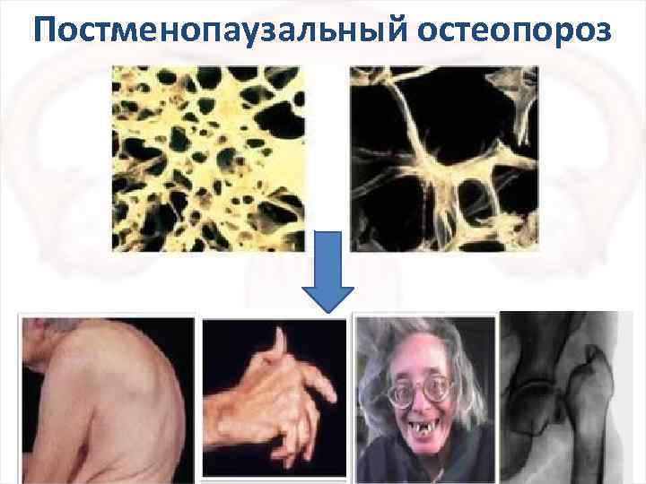 Постменопаузальный остеопороз 