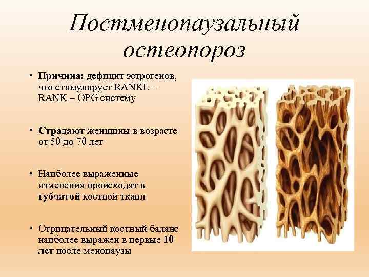 Постменопаузальный остеопороз • Причина: дефицит эстрогенов, что стимулирует RANKL – RANK – OPG систему