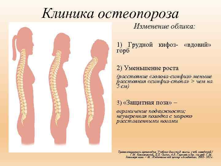 Клиника остеопороза Изменение облика: 1) Грудной кифоз- «вдовий» горб 2) Уменьшение роста (расстояние «голова-симфиз»