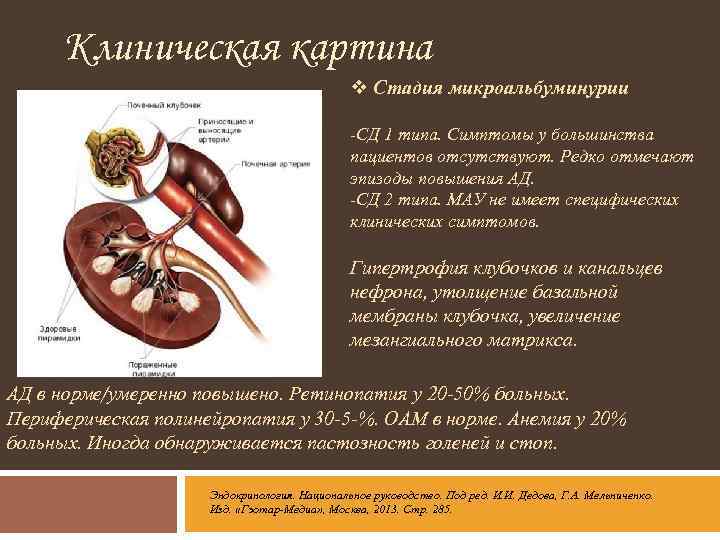 Клиническая картина v Стадия микроальбуминурии -СД 1 типа. Симптомы у большинства пациентов отсутствуют. Редко