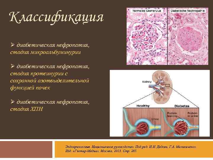 Классификация Ø диабетическая нефропатия, стадия микроальбуминурии Ø диабетическая нефропатия, стадия протеинурии с сохранной азотвыделительной