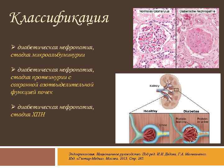 Диабетическая нефропатия презентация