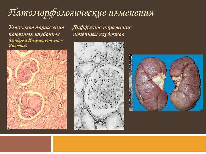 Патоморфологические изменения Узелковое поражение почечных клубочков (синдром Киммельстила – Уилсона) Диффузное поражение почечных клубочков