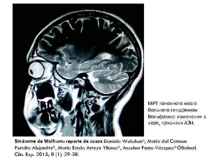 МРТ головного мозга больного синдромом Вольфрама: изменения в коре, признаки АЗН. Síndrome de Wolfram: