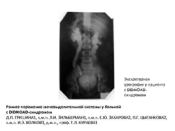 Экскреторная урография у пациента с DIDMOADсиндромом Раннее поражение мочевыделительной системы у больной с DIDMOAD-синдромом