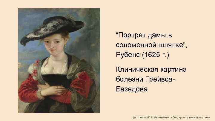 “Портрет дамы в соломенной шляпке”, Рубенс (1625 г. ) Клиническая картина болезни Грейвса. Базедова