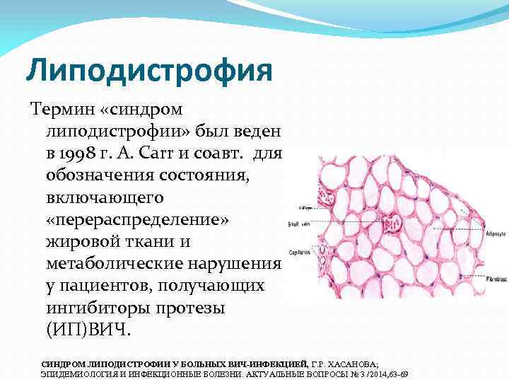 Липодистрофия Термин «синдром липодистрофии» был веден в 1998 г. А. Carr и соавт. для