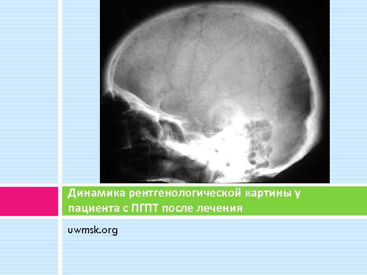 Динамика рентгенологической картины у пациента с ПГПТ после лечения uwmsk. org 