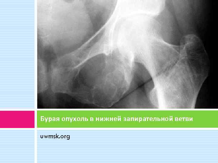 Бурая опухоль в нижней запирательной ветви uwmsk. org 