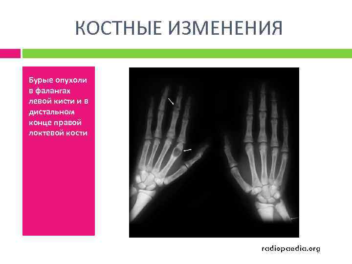 КОСТНЫЕ ИЗМЕНЕНИЯ Бурые опухоли в фалангах левой кисти и в дистальном конце правой локтевой