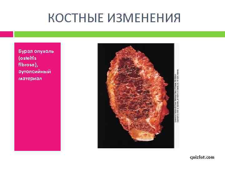 КОСТНЫЕ ИЗМЕНЕНИЯ Бурая опухоль (osteitis fibrosa), аутопсийный материал quizlet. com 