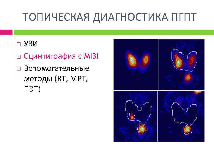 ТОПИЧЕСКАЯ ДИАГНОСТИКА ПГПТ УЗИ Сцинтиграфия с MIBI Вспомогательные методы (КТ, МРТ, ПЭТ) 