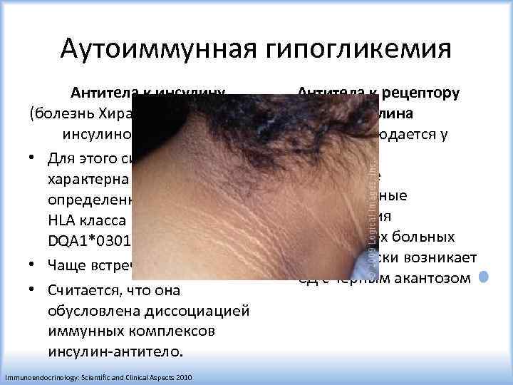 Аутоиммунная гипогликемия Антитела к рецептору Антитела к инсулину инсулина (болезнь Хирата, аутоиммунный • Чаще