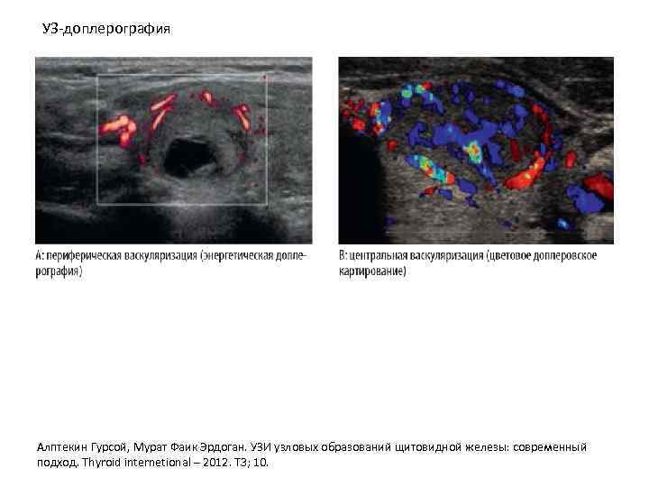 УЗ-доплерография Алптекин Гурсой, Мурат Фаик Эрдоган. УЗИ узловых образований щитовидной железы: современный подход. Thyroid