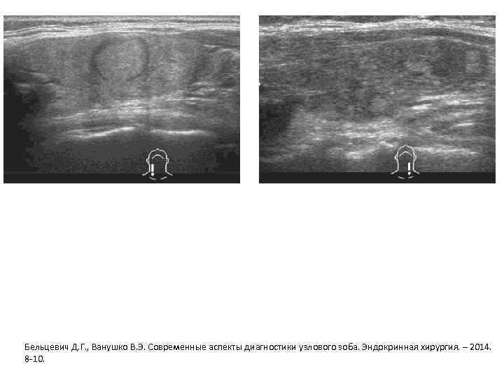 Бельцевич Д. Г. , Ванушко В. Э. Современные аспекты диагностики узлового зоба. Эндокринная хирургия.