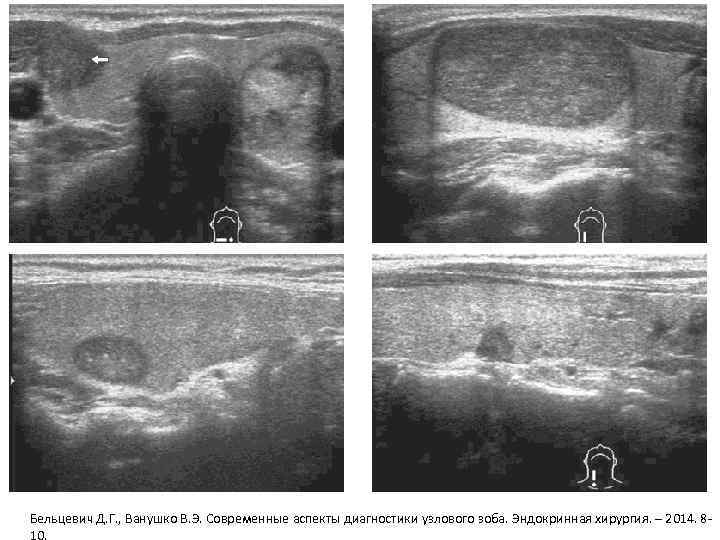 Бельцевич Д. Г. , Ванушко В. Э. Современные аспекты диагностики узлового зоба. Эндокринная хирургия.