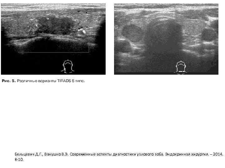 Бельцевич Д. Г. , Ванушко В. Э. Современные аспекты диагностики узлового зоба. Эндокринная хирургия.