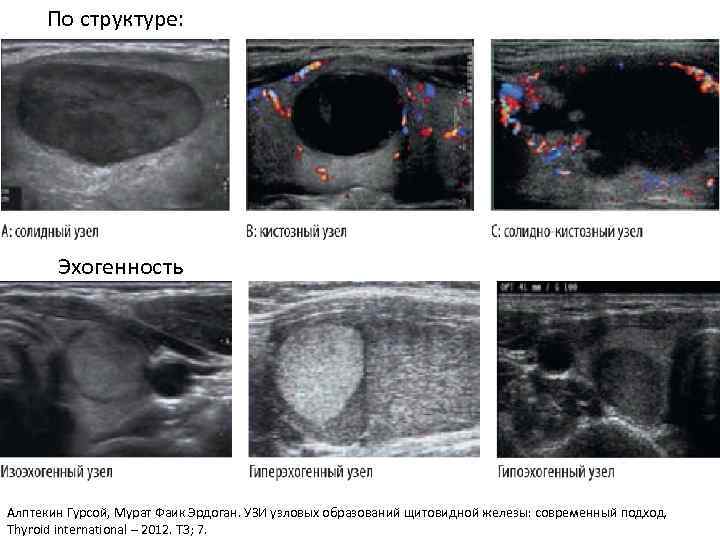 По структуре: Эхогенность Алптекин Гурсой, Мурат Фаик Эрдоган. УЗИ узловых образований щитовидной железы: современный