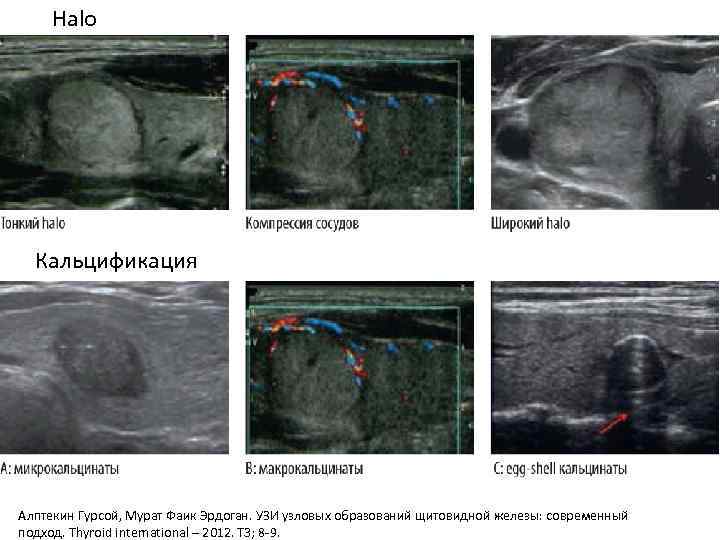 Halo Кальцификация Алптекин Гурсой, Мурат Фаик Эрдоган. УЗИ узловых образований щитовидной железы: современный подход.