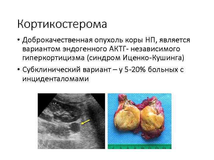 Кортикостерома • Доброкачественная опухоль коры НП, является вариантом эндогенного АКТГ- независимого гиперкортицизма (синдром Иценко-Кушинга)