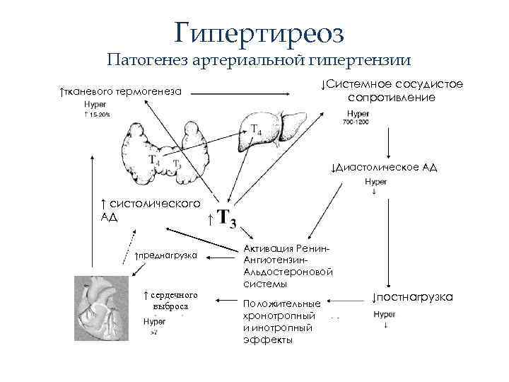 Гипертиреоз Патогенез артериальной гипертензии ↑тканевого термогенеза ↓Системное сосудистое сопротивление ↓Диастолическое АД ↑ систолического АД