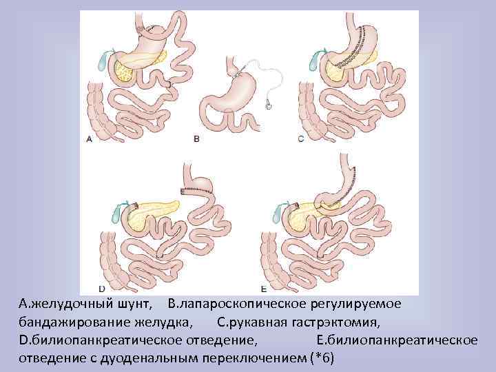 A. желудочный шунт, B. лапароскопическое регулируемое бандажирование желудка, C. рукавная гастрэктомия, D. билиопанкреатическое отведение,