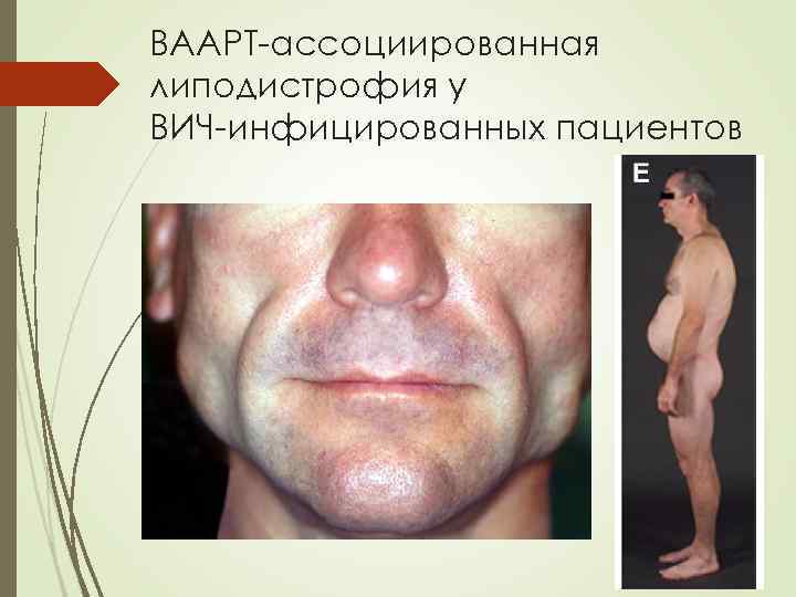 ВААРТ-ассоциированная липодистрофия у ВИЧ-инфицированных пациентов 