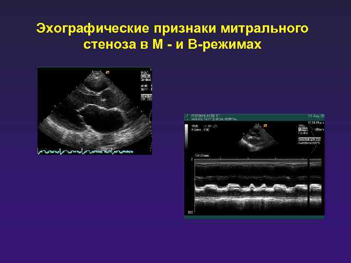 Эхографические признаки митрального стеноза в М - и В-режимах 