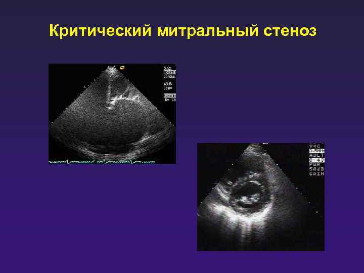 Митральный стеноз схема