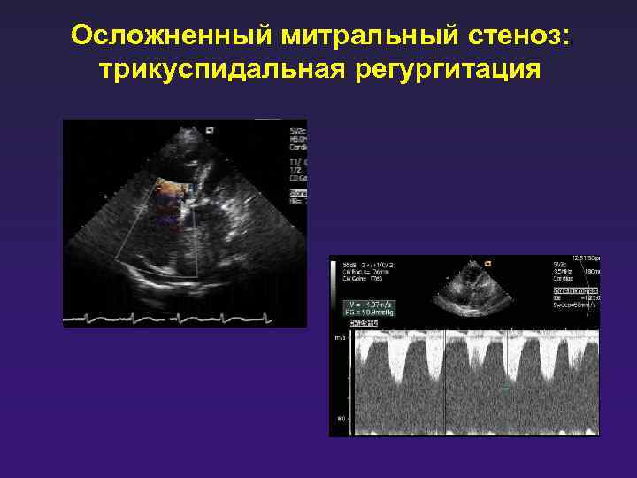 Осложненный митральный стеноз: трикуспидальная регургитация 
