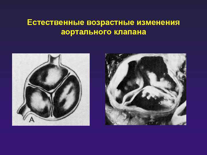 Очаговый кальциноз аортального клапана