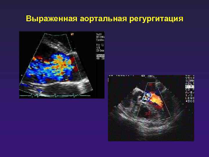 Выраженная аортальная регургитация 