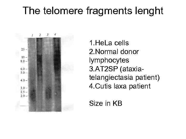 The telomere fragments lenght 1. He. La cells 2. Normal donor lymphocytes 3. AT