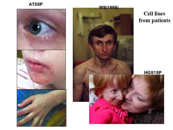 AT 8 SP WS(1609) Cell lines from patients HGS 1 SP 