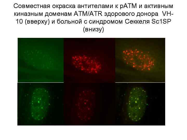 Совместная окраска антителами к р. АТМ и активным киназным доменам АТМ/АTR здорового донора VH