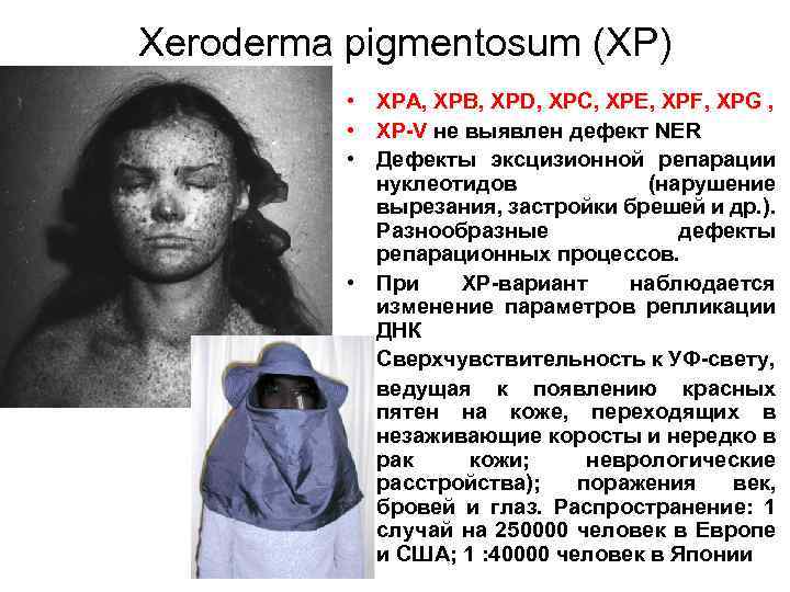 Xeroderma pigmentosum (XP) • XPA, XPB, XPD, XPC, XPE, XPF, XPG , • XP-V