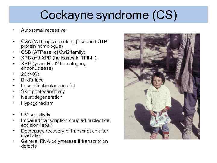 Cockayne syndrome (CS) • Autosomal recessive • CSA (WD-repeat protein, β-subunit GTP protein homologue)