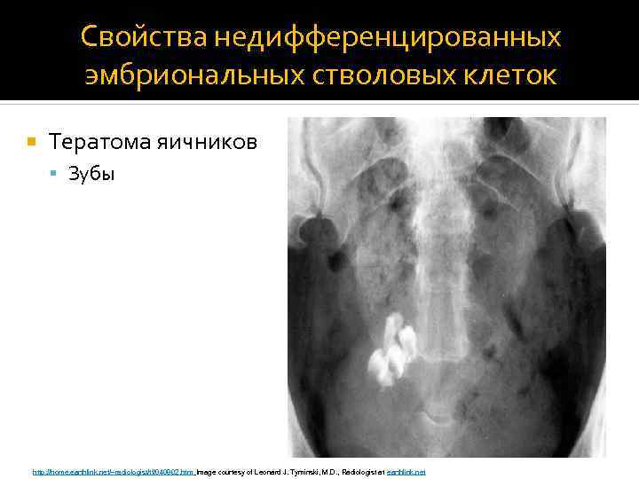 Свойства недифференцированных эмбриональных стволовых клеток Тератома яичников Зубы http: //home. earthlink. net/~radiologist/tf/040802. htm Image